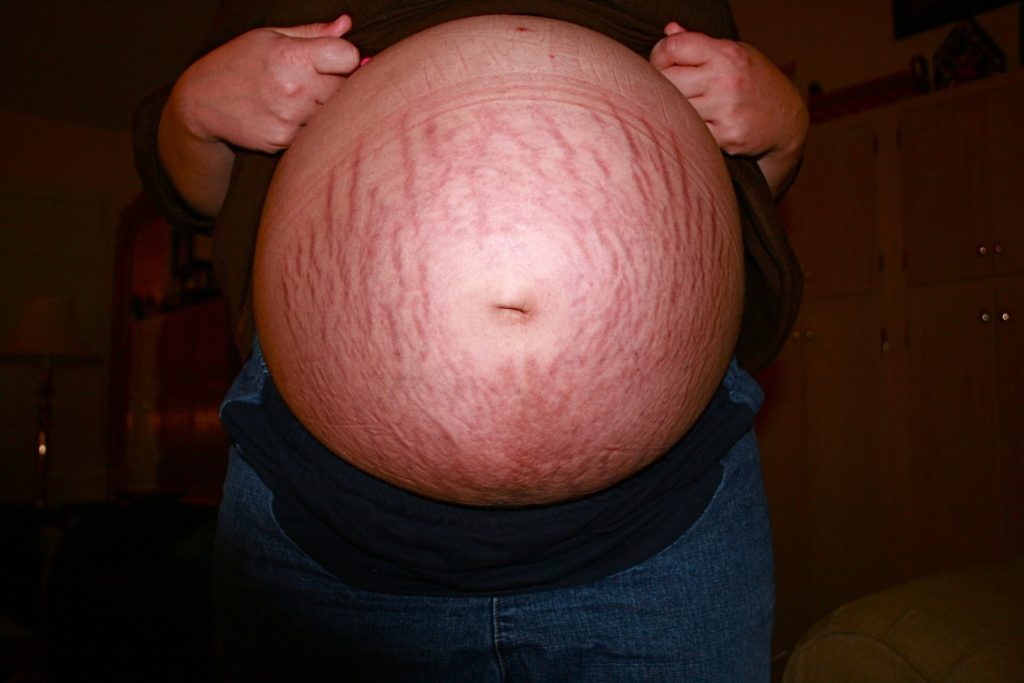 stretch marks, Pregnant